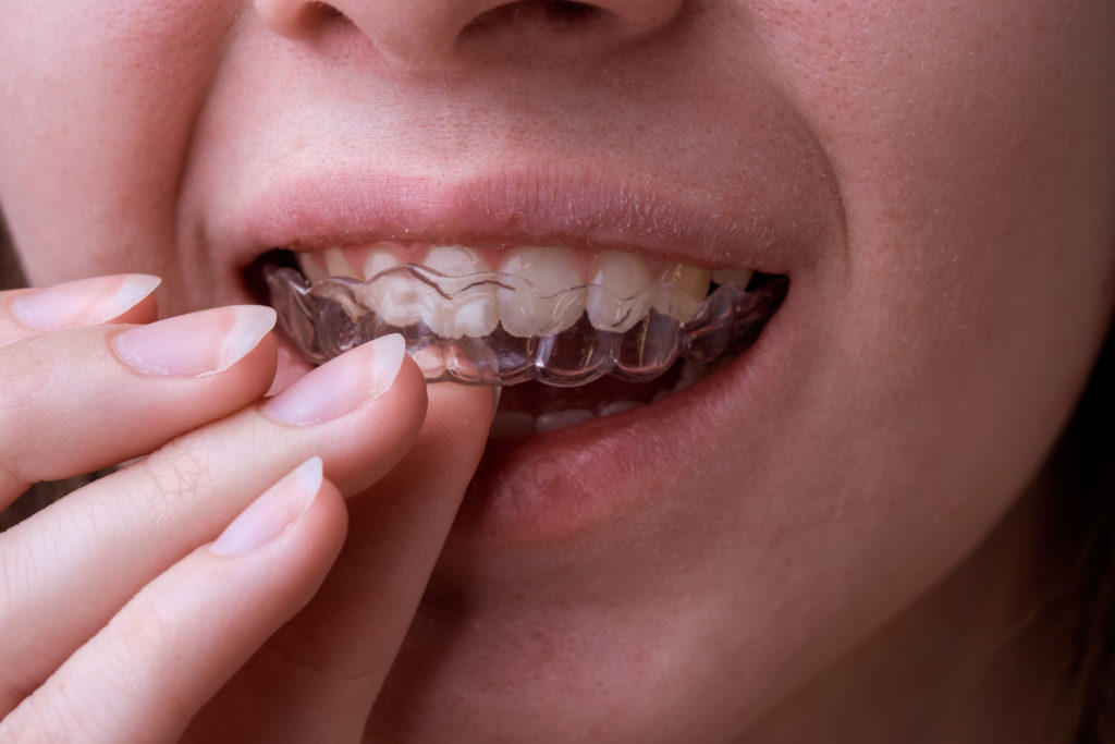 Gouttière dentaire de protection / protège-dents sport sur mesure : prix et  infos au Luxembourg - Orthodontie & Dentiste Luxembourg - Dudelange