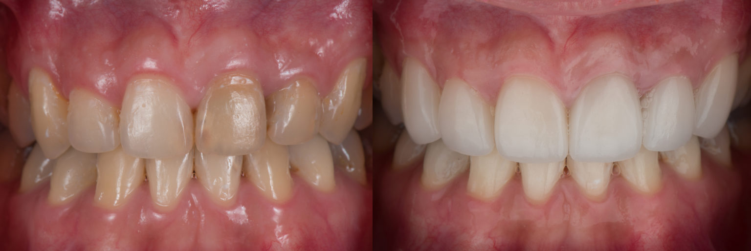 Facettes esthétiques, sans tailler ni limer la dent Dr ARNOULD TANSON