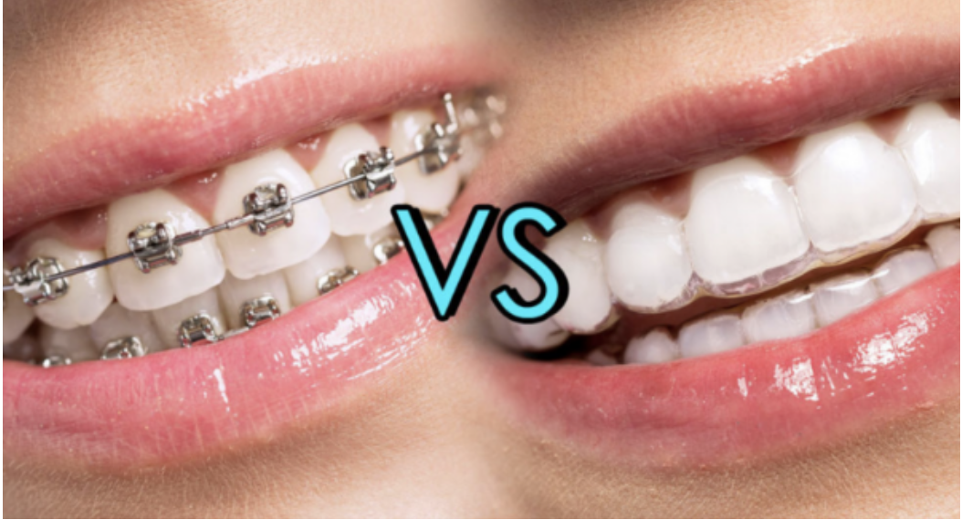 SCHIFFLANGE : protège-dents sur mesure pour Boxe, Rugby et sport -  Orthodontie & Dentiste Luxembourg - Dudelange
